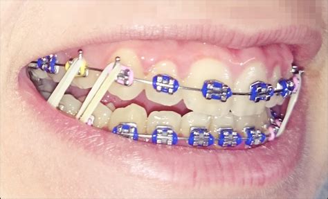 para que sirven las ligaduras metalicas en los brackets|gomas de brackets.